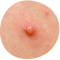 pox-2
